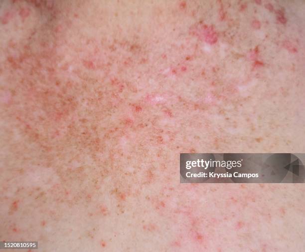 Cancer Rash Lumps Skin Cancer Symptoms - Fotografias e Filmes do Acervo - Getty Images