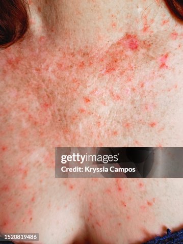 Pink Rash Scabs Red Skin Rash With Bumps Scabs Psoriasis Skin High-Res Stock Photo ...