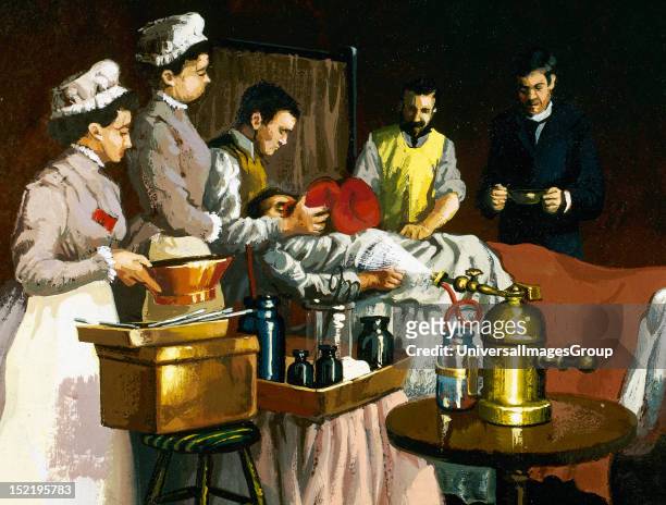 William Thomas , American dentist, who first successfully used ether as an anesthetic in surgery, Representation of an intervention at Bellevue...