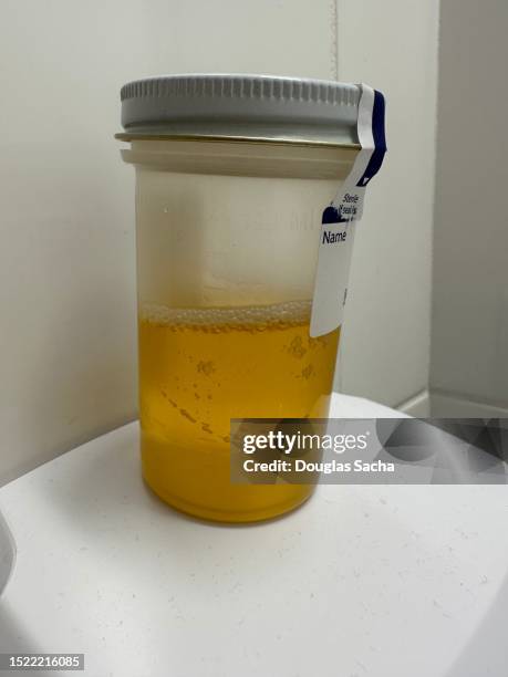 urine sample in a clinical specimen container - a container for urine stock-fotos und bilder