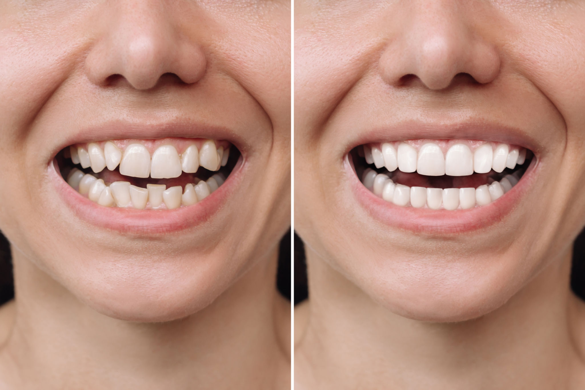 braces comparison