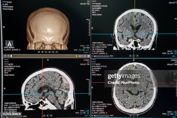 General view showing a display screen showing a CT Scan of a brain inside the Central Government-aided Emergency Hospital on July 11, 2023 in Hong...