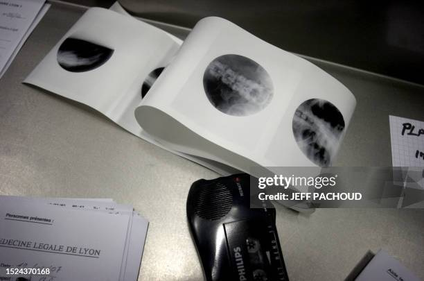 Handheld recorder of a forensic scientist and an x-ray are seen 12 February 2007 at the forensic medicine institute in Lyon during an autopsy. Un...