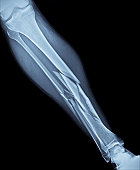 Broken Leg X-Ray