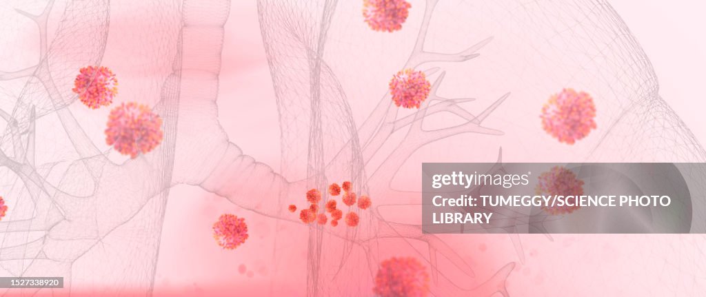 Respiratory syncytial virus infection, illustration