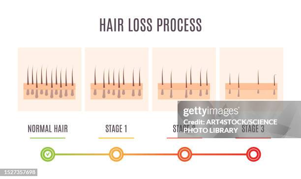 ilustraciones, imágenes clip art, dibujos animados e iconos de stock de hair loss process, conceptual illustration - human scalp