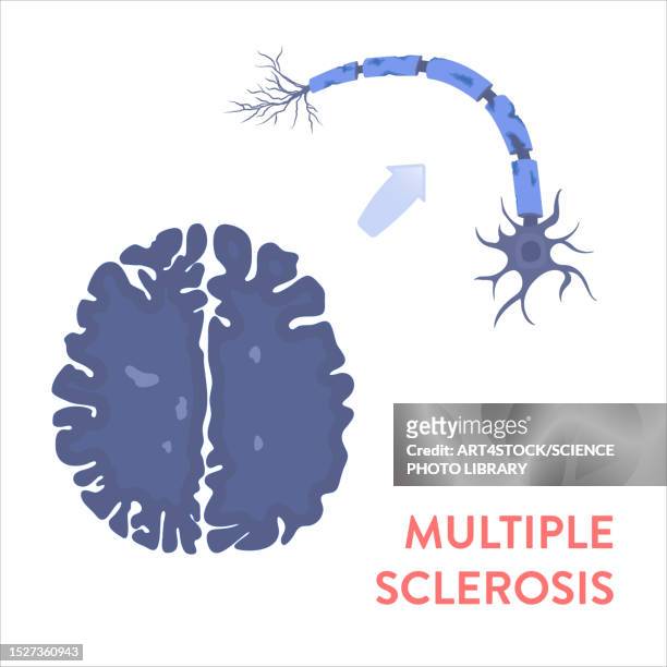 multiple sclerosis, conceptual illustration - autoimmune disease 幅插畫檔、美工圖案、卡通及圖標