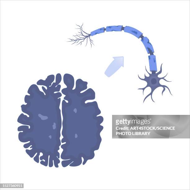 multiple sclerosis, conceptual illustration - autoimmune disease stock-grafiken, -clipart, -cartoons und -symbole