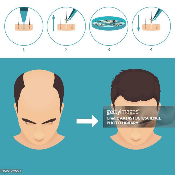 fue hair transplantation, illustration - completely bald stock illustrations