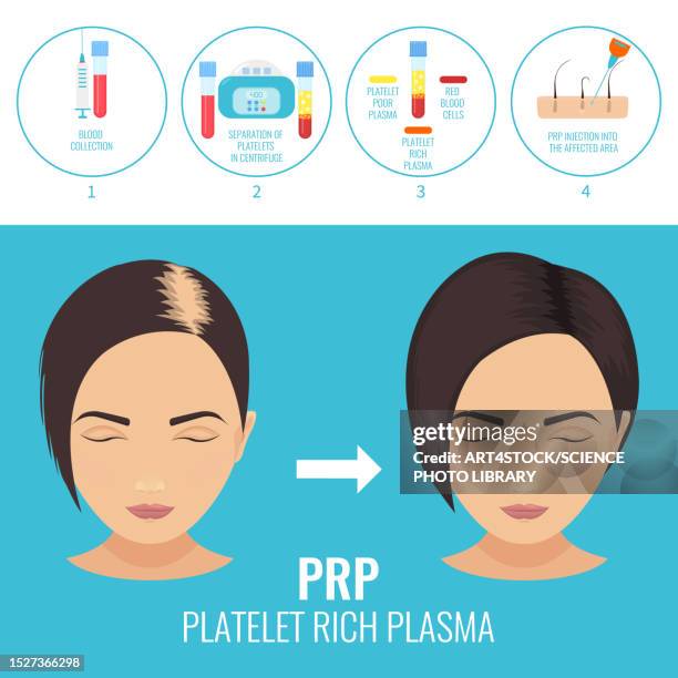 prp hair loss treatment, illustration - surgical equipment stock illustrations