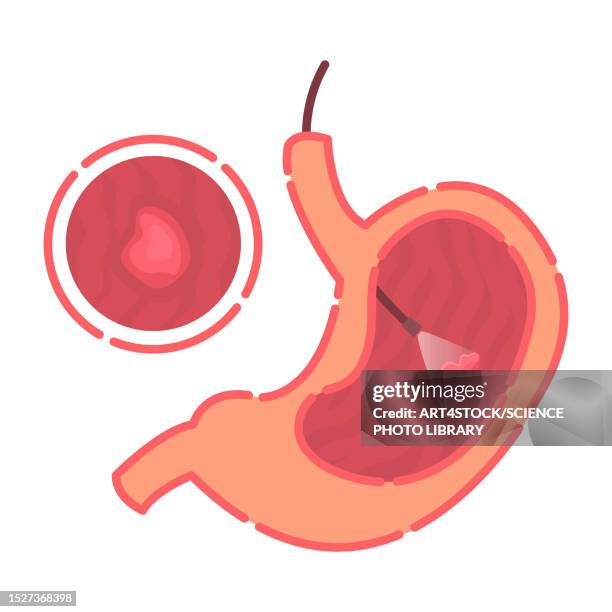 stomach gastroscopy, illustration - 内視鏡点のイラスト素材／クリップアート素材／マンガ素材／アイコン素材
