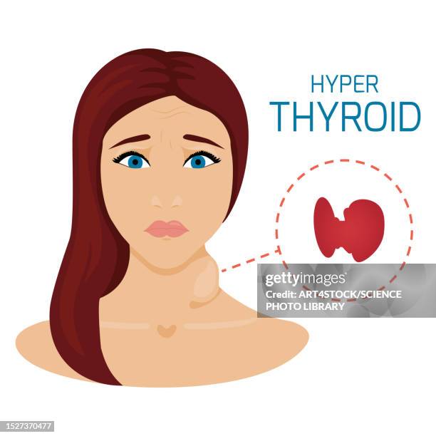 ilustraciones, imágenes clip art, dibujos animados e iconos de stock de thyroid disorder, conceptual illustration - goiter