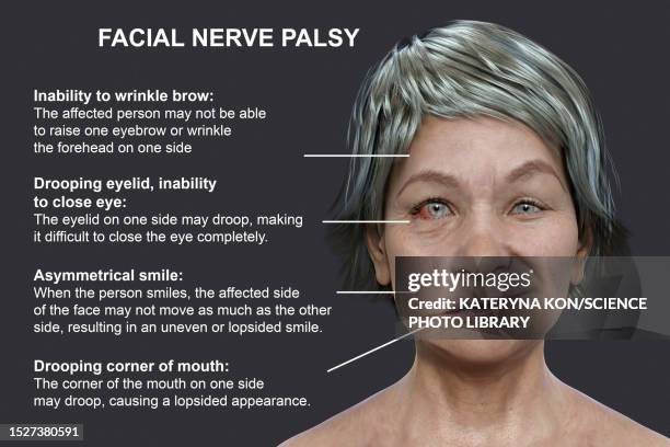 facial palsy, illustration - face drooping stock illustrations