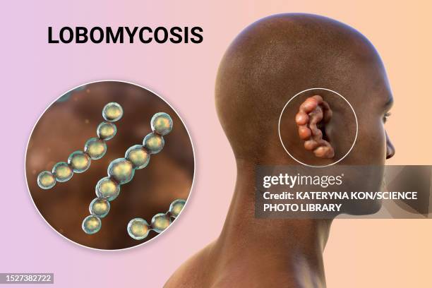 ilustraciones, imágenes clip art, dibujos animados e iconos de stock de lobomycosis fungal infection, illustration - blastomicosis