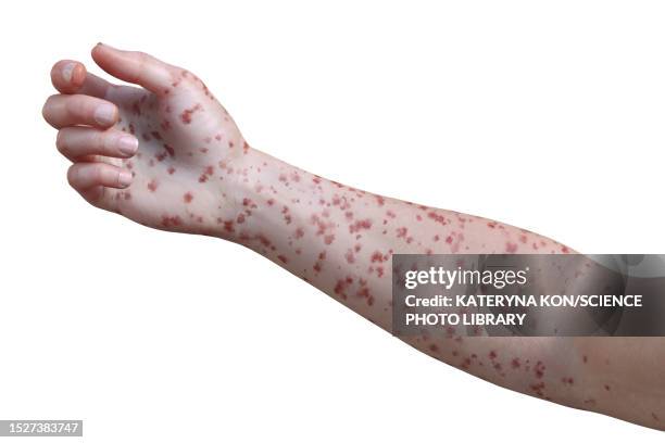 rash in marburg haemorrhagic fever, illustration - skin rash stock illustrations