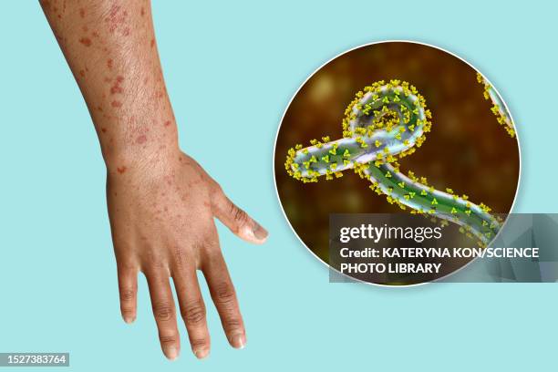Patechi Rach 16 Petechiae Rash High Res Illustrations - Getty Images