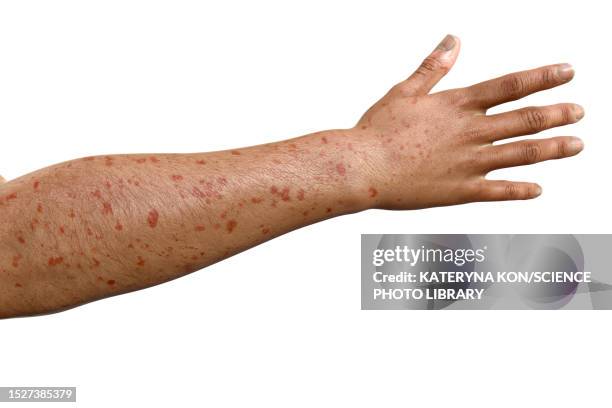 stockillustraties, clipart, cartoons en iconen met rash in marburg haemorrhagic fever, illustration - petechiae