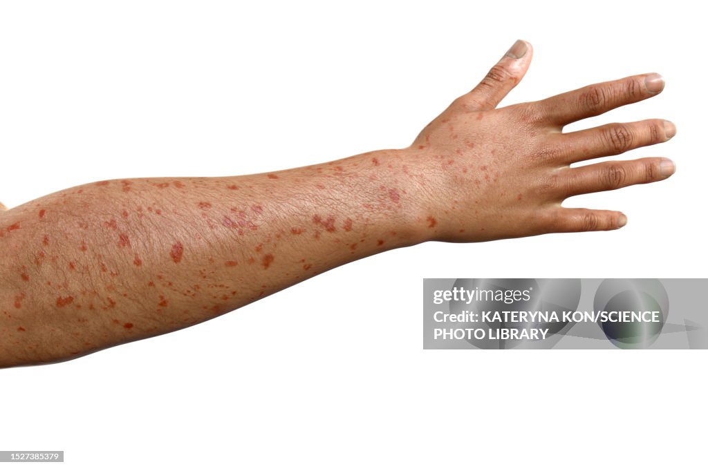 Rash In Marburg Haemorrhagic Fever Illustration High-Res Vector Graphic ...