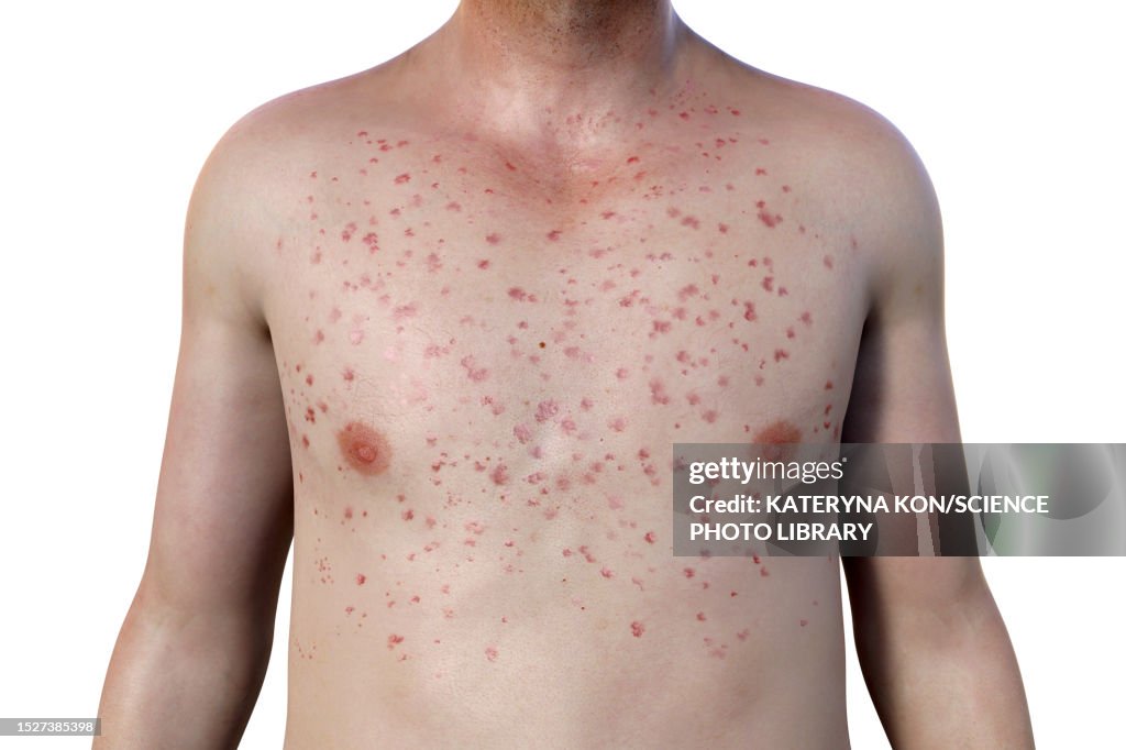 Rash In Marburg Haemorrhagic Fever Illustration High-Res Vector Graphic ...