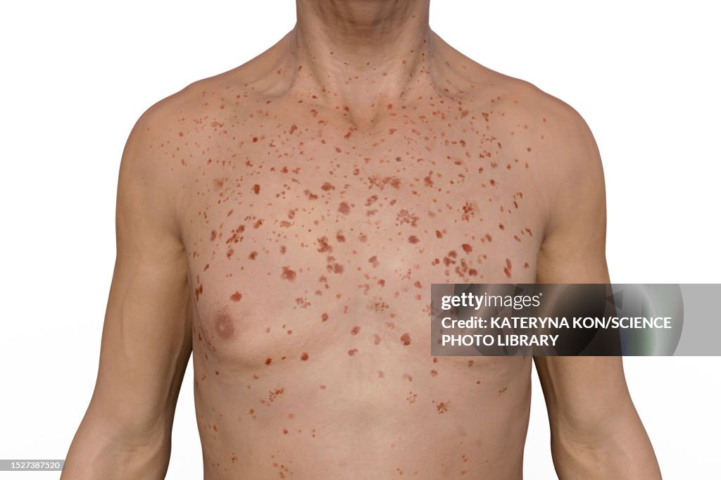 Marburg Rash Rash In Marburg Haemorrhagic Fever Illustration High-Res Vector Graphic ...