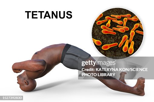 Tetanus Graphics Tetanus Illustration High-Res Vector Graphic - Getty Images