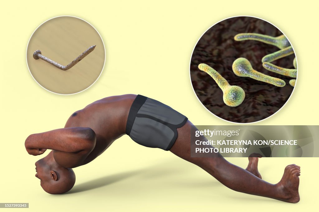 Tetanus Illustration High Res Vector Graphic Getty Images tetanus-illustration-high-res-vector-graphic-getty-images