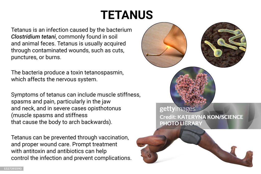 Tetanus Graphics Tetanus Illustration High-Res Vector Graphic - Getty Images