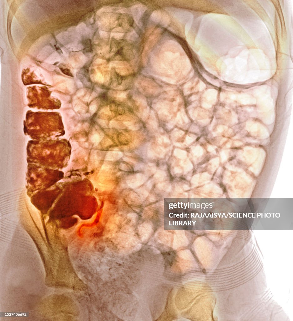 Normal Appendix Dissection Normal Appendicography High-Res Stock Photo - Getty Images