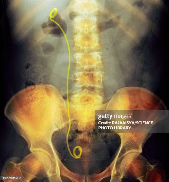 Urinary System Rq 52 Kidney Catheter Stock Photos, High-Res Pictures, and Images - Getty ...