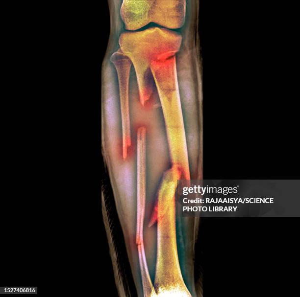 fractured leg, x-ray - comminuted fracture stock pictures, royalty-free photos & images