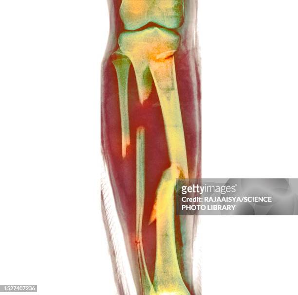 fractured leg, x-ray - comminuted fracture stock pictures, royalty-free photos & images
