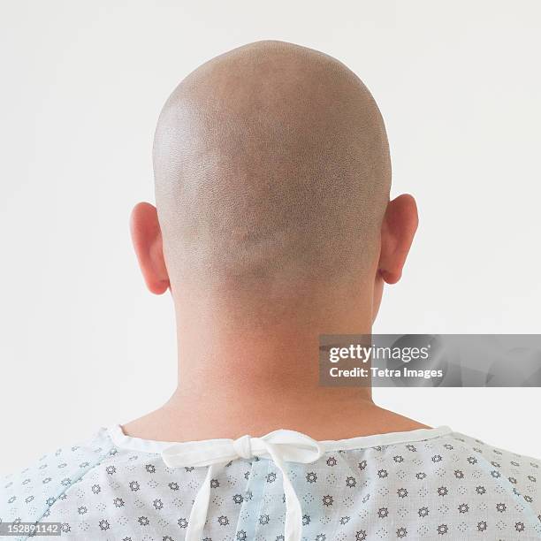 back view of patient with shaved head - shaved-buzz-cut-back-of-head photos et images de collection