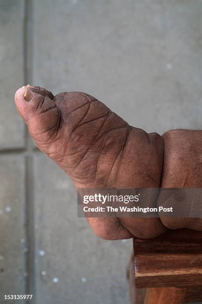 The foot, of a patient of Dr. Luccene Desir, director of the Center of Research for Filariasis in Haiti at a hospital in Leogane, south of the...