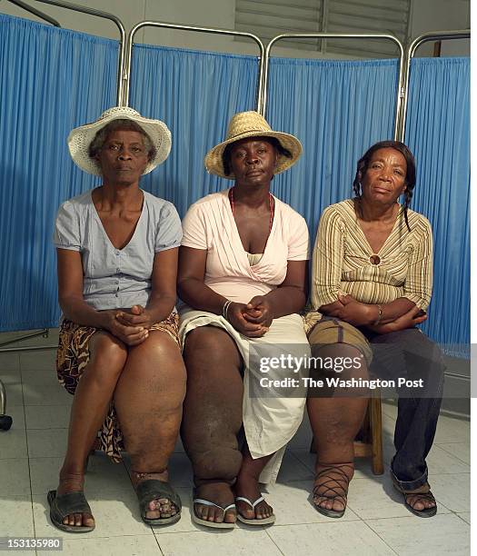 Three female patients of Dr. Luccene Desir, director of the Center of Research for Filariasis in Haiti display their legs affected by elephantiasis...