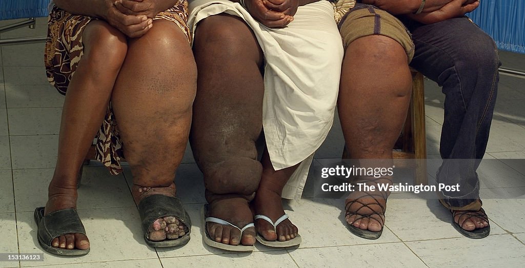 Haiti elephantasis