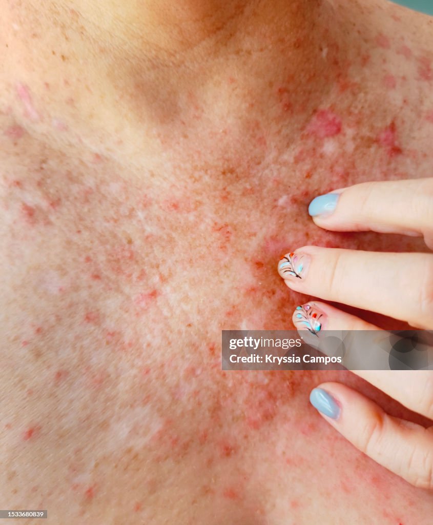 Instant Rash On Chest Rash Upper Chest And Neck Stress Rash: What To Do When Stress Gives
