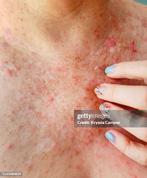 woman's hand scratching her chest and neck with an affectation on her skin - skin rash stock pictures, royalty-free photos & images