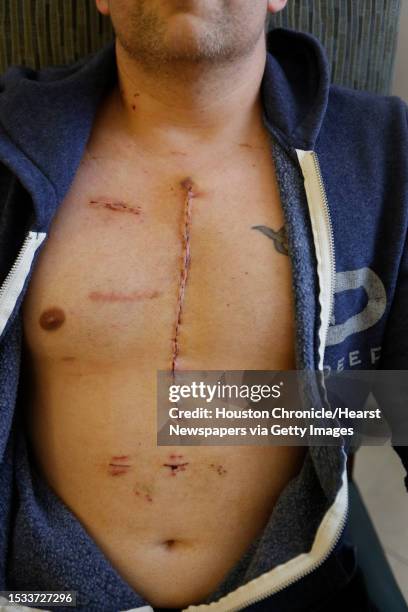 Minutes before being discharged from Methodist DeBakey Heart & Vascular Center, Saturday, Dec. 5 in Houston Chriss Schwidierski sits with his sweat...