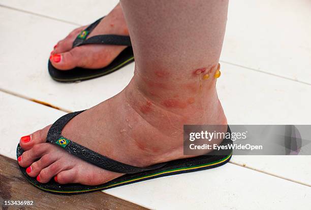 Infected bites of sandflies at the swollen feet of a woman at Compass Cay Marina on June 15, 2012 in the Islands of the Exumas, The Bahamas.