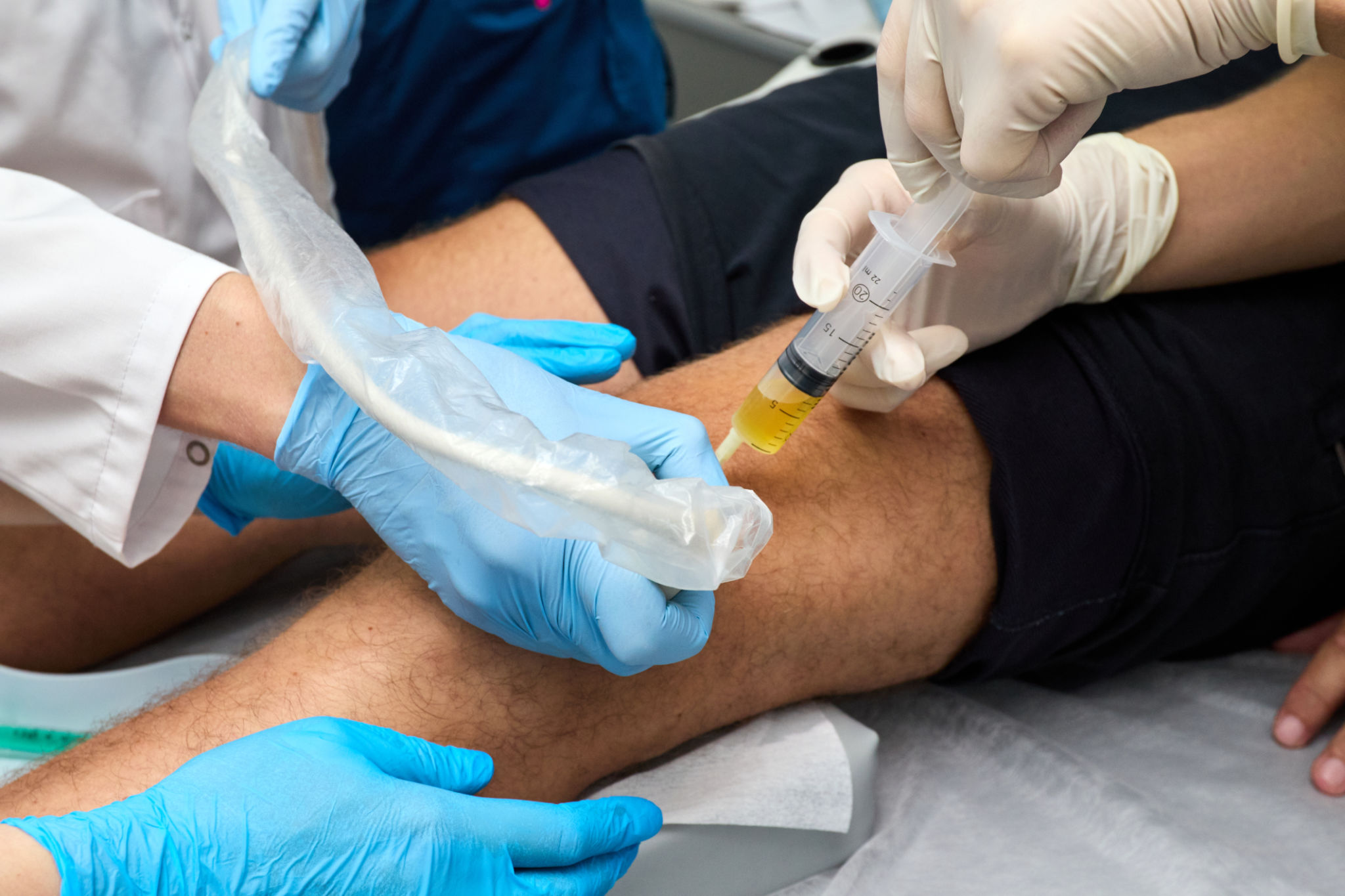 escleroterapia