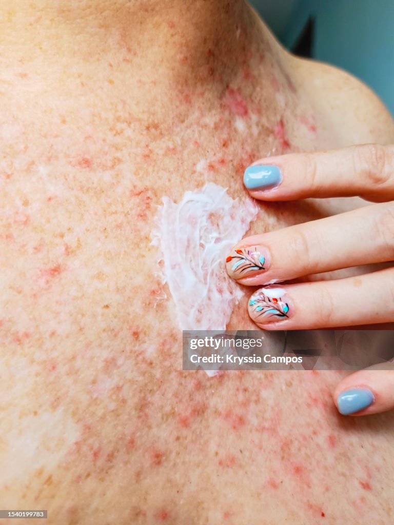 Woman's Hand Applying Medicinal Cream on Her Chest and Neck with an Affectation on Her Skin