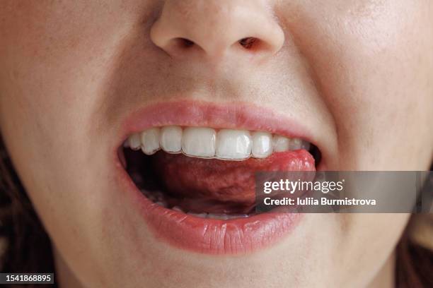 female dental specialist playfully licks teeth with tongue during dental treatment with teeth aligners - boca abierta fotografías e imágenes de stock