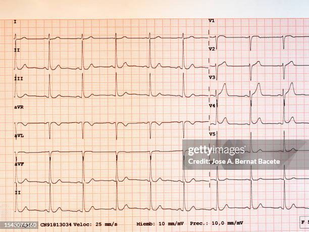 result of an electrocardiogram printed on paper. - rythme cardiaque photos et images de collection