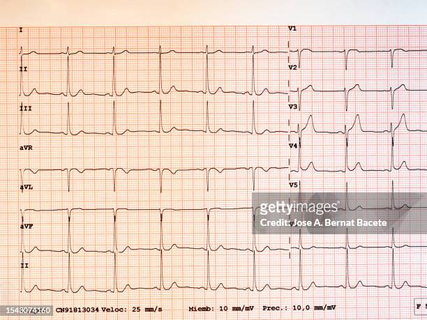 result of an electrocardiogram printed on paper. - pulse trace stockfoto's en -beelden