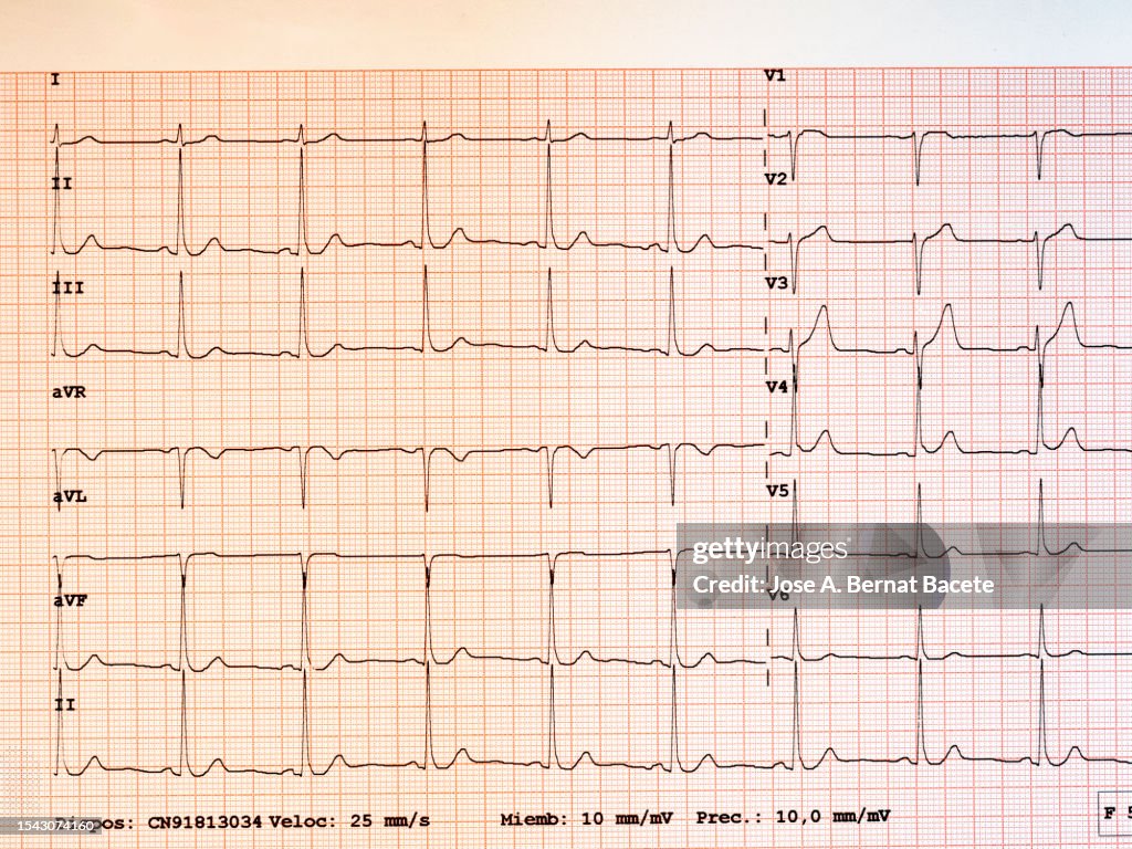 Result of an electrocardiogram printed on paper.