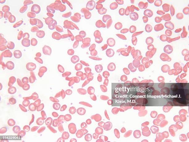 an image of sickle cell blood smear - anemia fotografías e imágenes de stock