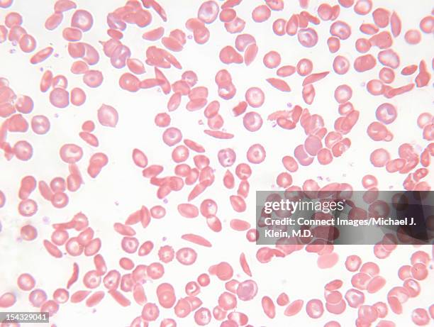 an image of sickle cell blood smear - sickle cell stock pictures, royalty-free photos & images