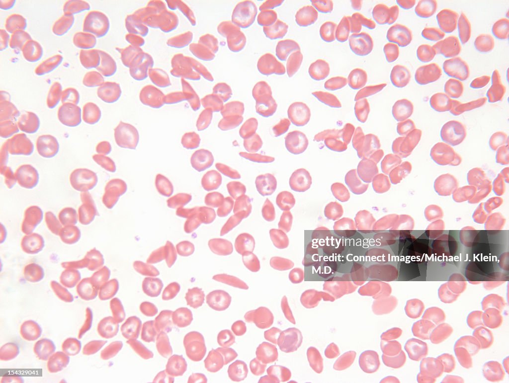 An image of sickle cell blood smear