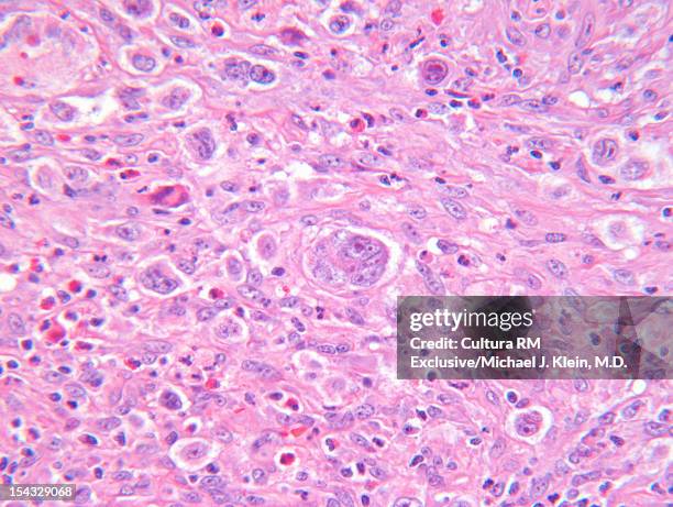 an image of hodgkins disease cells - lymphoma 個照片及圖片檔