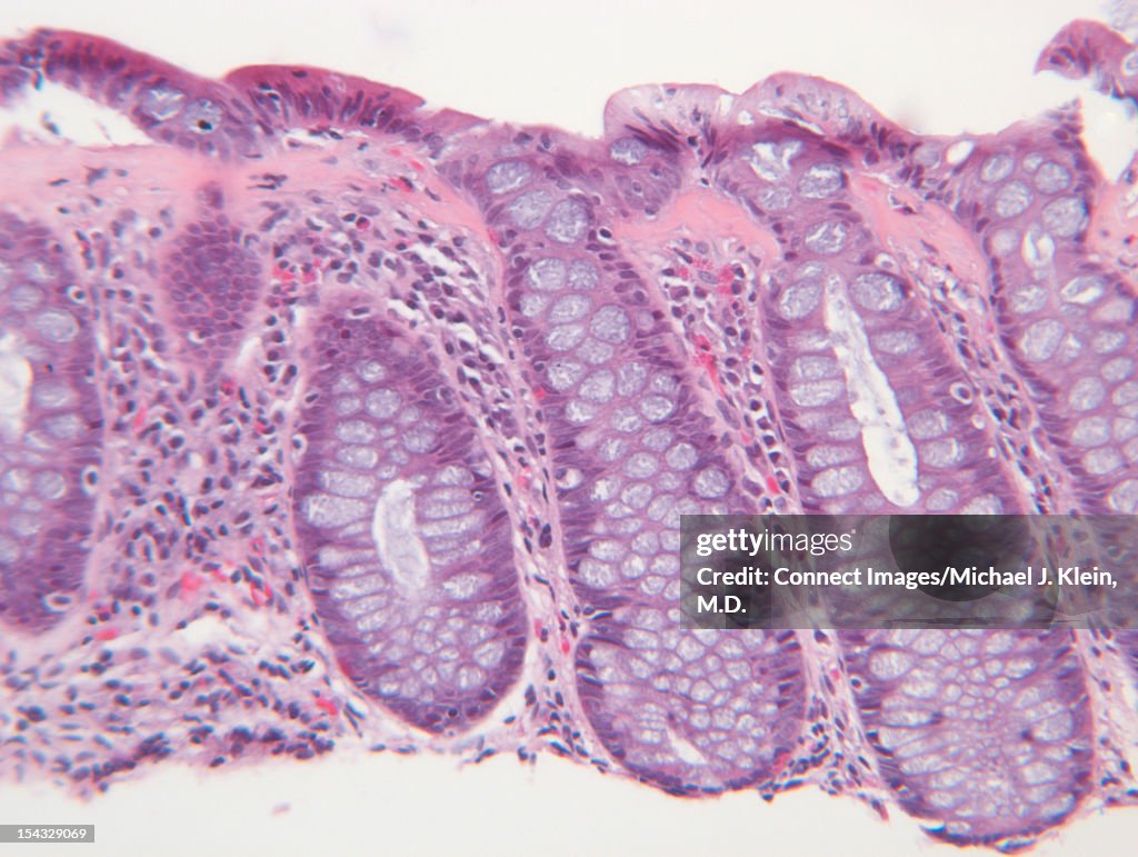 An image of collagenous colitis cells